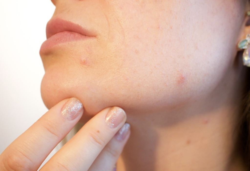 women-with-acne