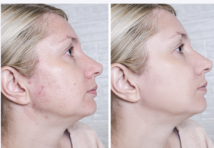 chebula for acne - chebula acne benefits - chebula.net